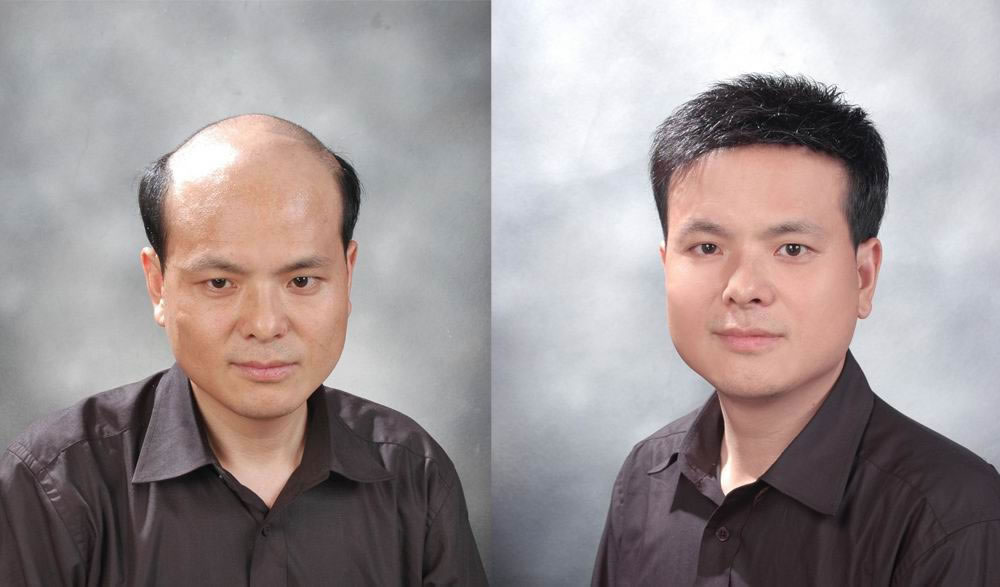 脫發(fā)嚴(yán)重怎么辦_脂溢性脫發(fā)怎么辦_脫發(fā)怎么辦 ?唐總本人照片 脫發(fā)嚴(yán)重怎么辦_脂溢性脫發(fā)怎么辦_脫發(fā)怎么辦 ?唐總本人照片