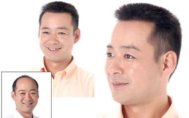 脂溢性脫發(fā)吃什么好 脂溢性脫發(fā)吃什么好