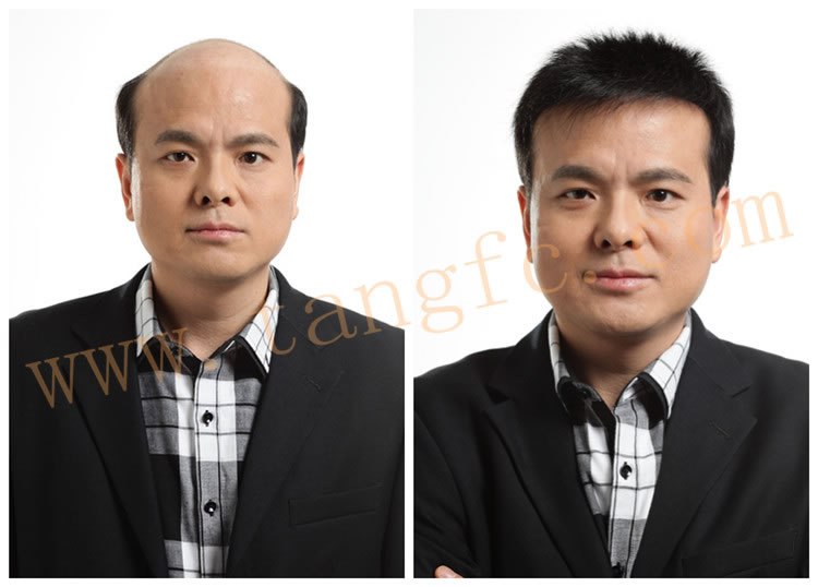 男士怎樣補(bǔ)發(fā)效果更真 男士怎樣補(bǔ)發(fā)效果更真