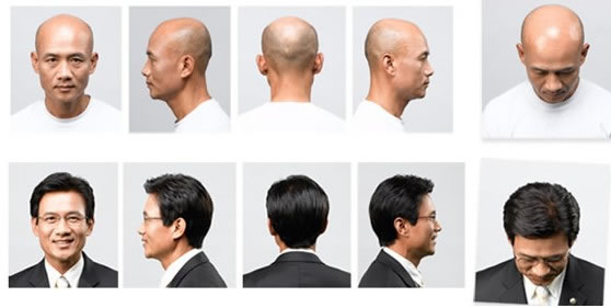 廣州這邊禿頂怎么辦？可以修復(fù)么？