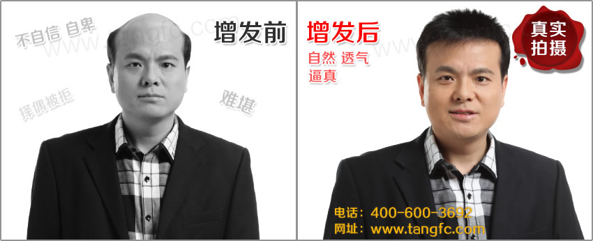 男士禿頂是普見的現象么？