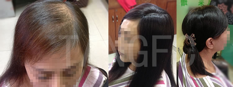 頭發(fā)稀少加密 \