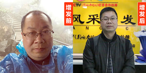 預(yù)防斑禿注意事項(xiàng)有哪些？看了好心酸