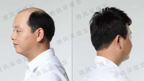 掉頭發(fā)禿頂怎么辦？45歲大叔容貌似90后！