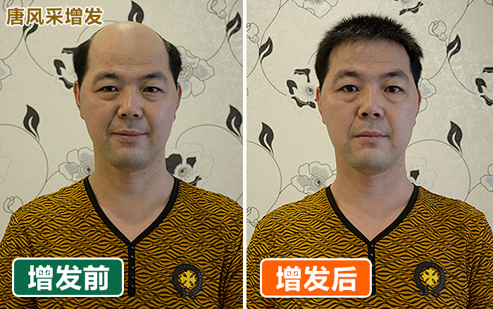 年輕頭發(fā)稀少怎么辦？唐風采假發(fā)讓你立即變濃密！