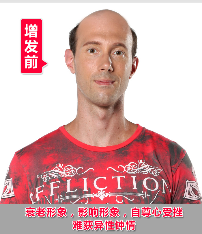 得了慢性脂溢性脫發(fā)，引起禿頭怎么辦？