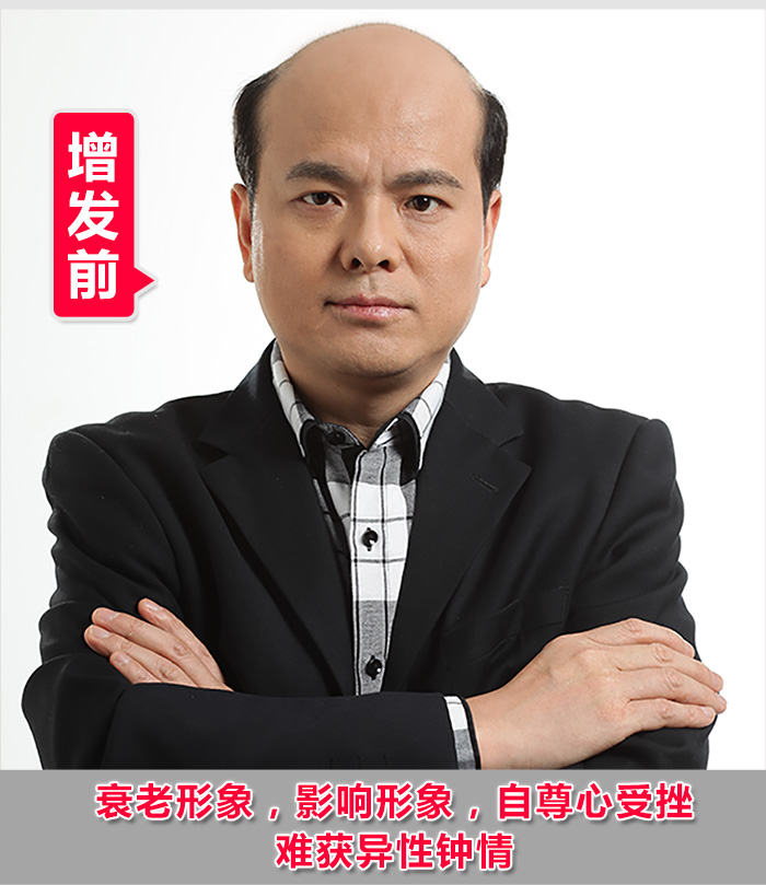 掉頭發(fā)很厲害怎么辦？2016新解決掉發(fā)的方法