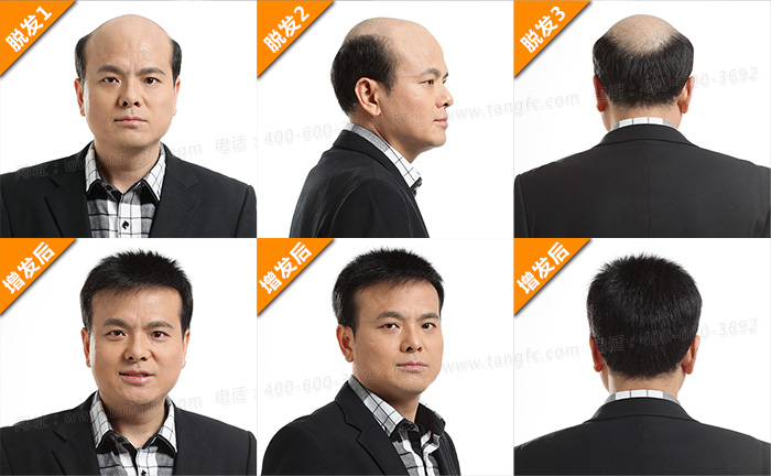 常德專業(yè)織發(fā)補(bǔ)發(fā)，織發(fā)補(bǔ)發(fā)也講究“藝術(shù)”