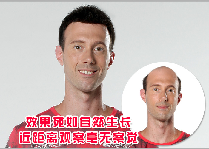 脫發(fā)患者機(jī)會來了，常德補(bǔ)發(fā)機(jī)構(gòu)，你準(zhǔn)備好了嗎？