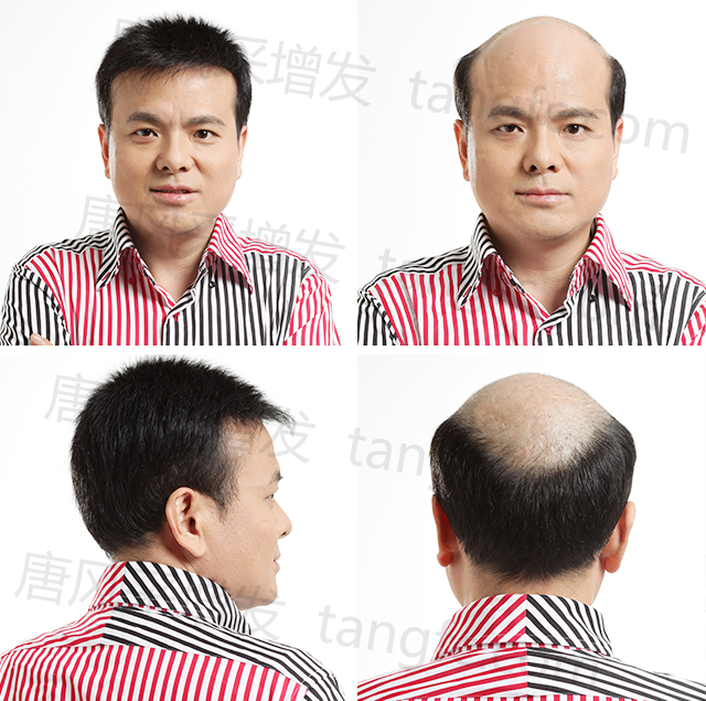 紹興織發(fā)補發(fā)需要多少錢？收費公開透明的就是它