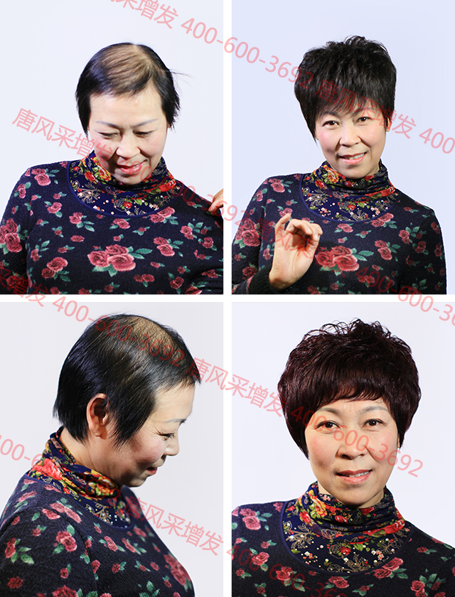 合肥織發(fā)定制解決脫發(fā)，什么品牌值得信賴？