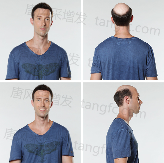 發(fā)際線高的同學，在同齡人中立馬看出年齡差距&nbsp;