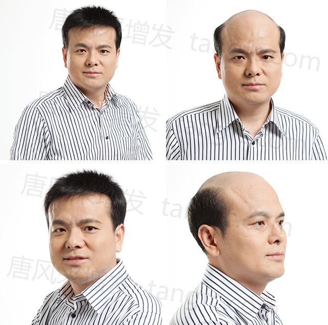 禿頂幾時(shí)休？且看唐風(fēng)采假發(fā)大刀闊斧使絕招！