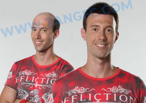 肌肉男多光頭？警惕激素脫發(fā)問題！