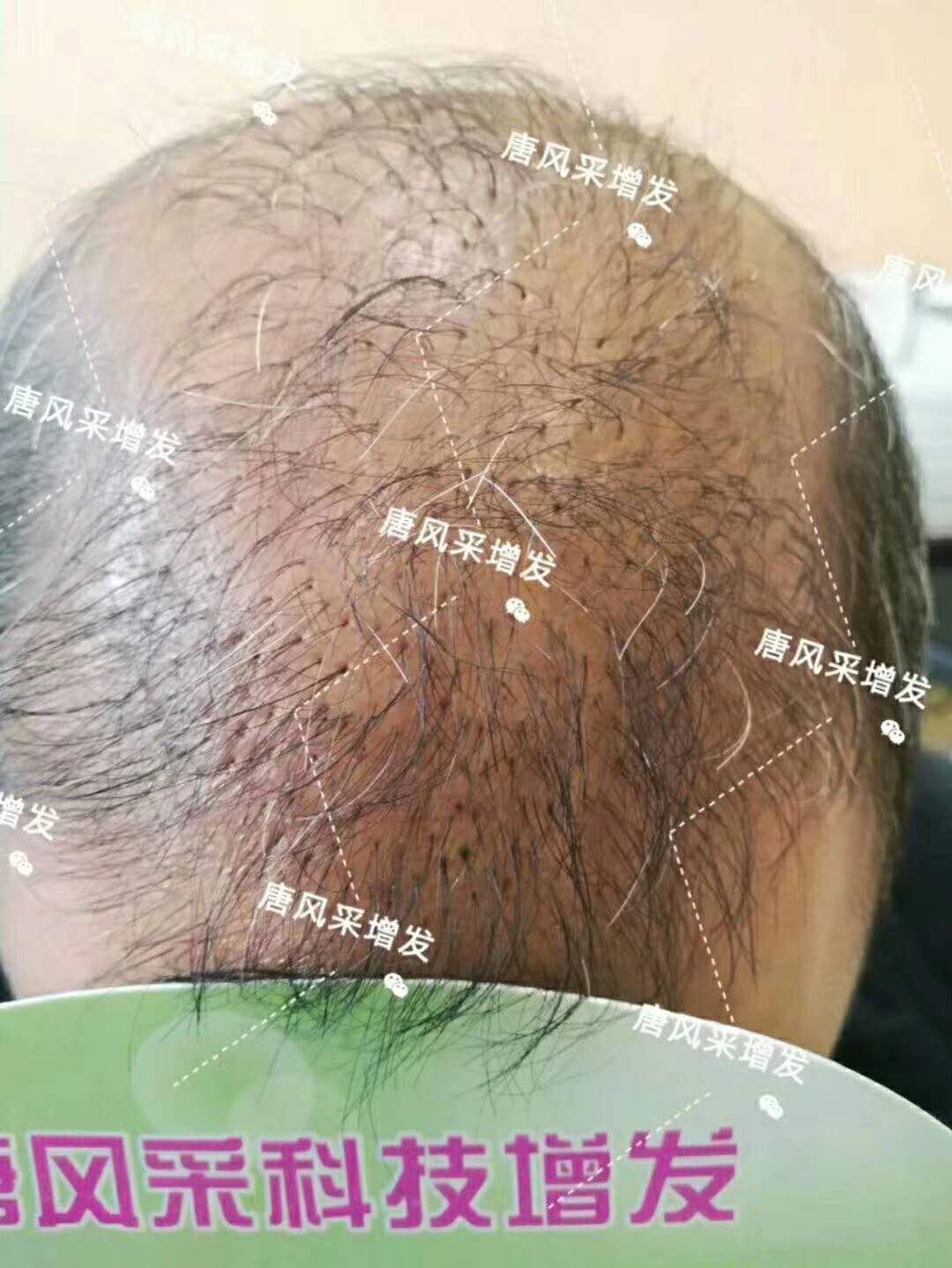 頭發(fā)稀少怎么變密？