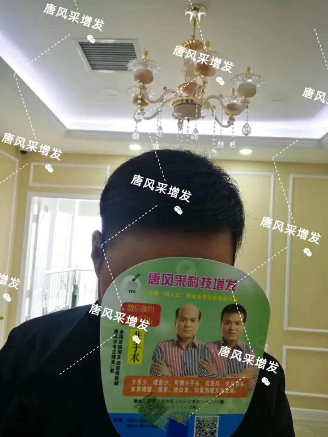 頭發(fā)稀少怎么變密？