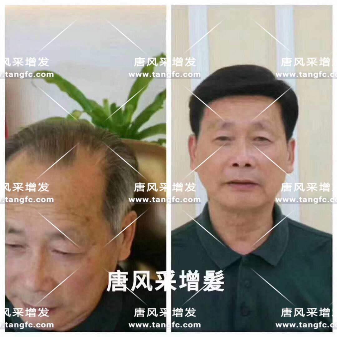 謝頂會(huì)坑一輩子？ 我不禁摸了摸自己頭發(fā)