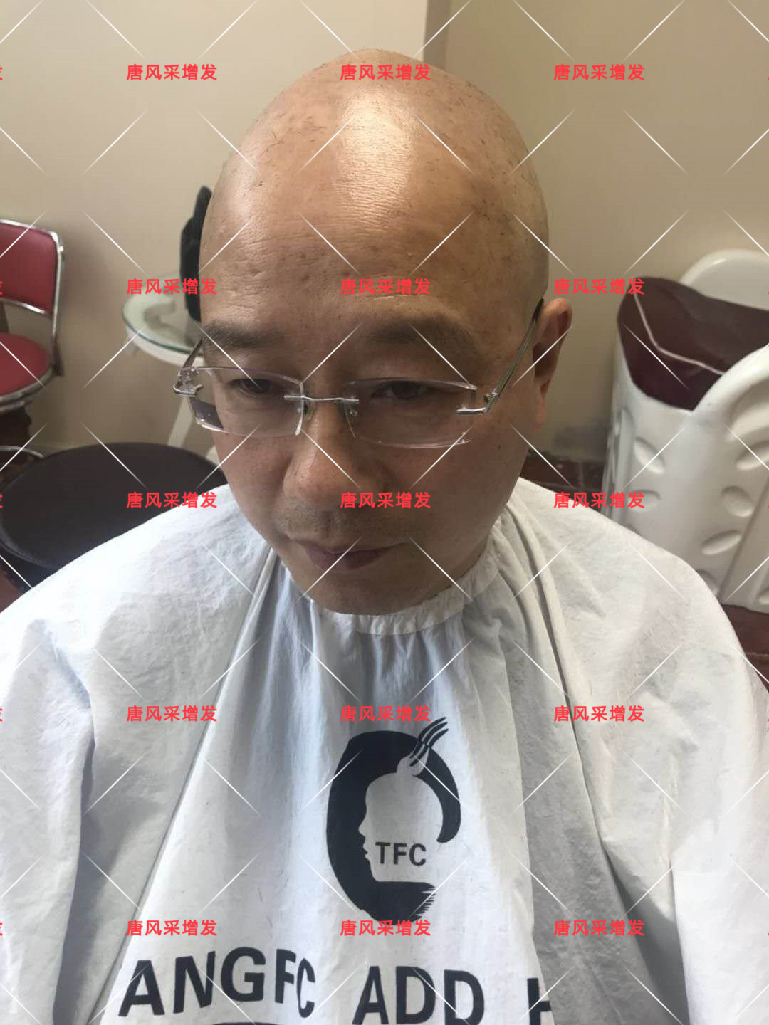 10年脫發(fā)困擾，一次性解決，唐風(fēng)采助力查先生“夢想成真”