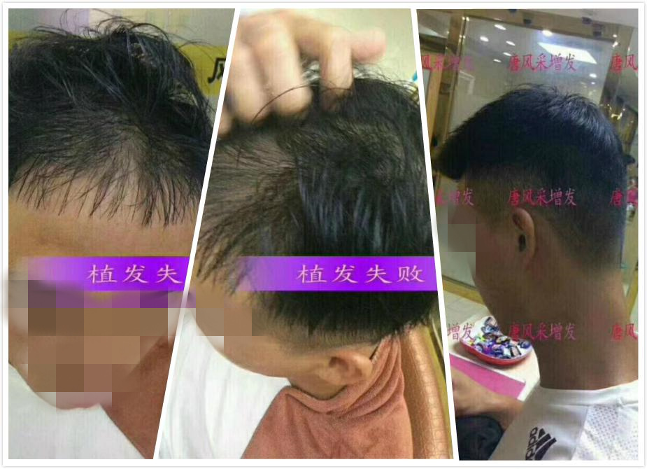 開始脫發(fā)的朋友上醫(yī)院，見到專家后他徹底絕望了！