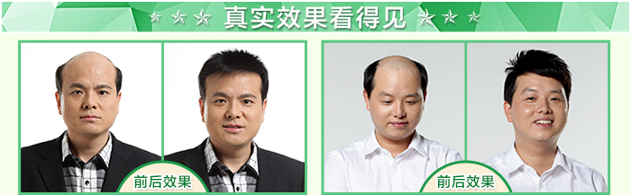 臺(tái)州真發(fā)假發(fā)哪有賣，夏天戴假發(fā)會(huì)悶熱嗎？