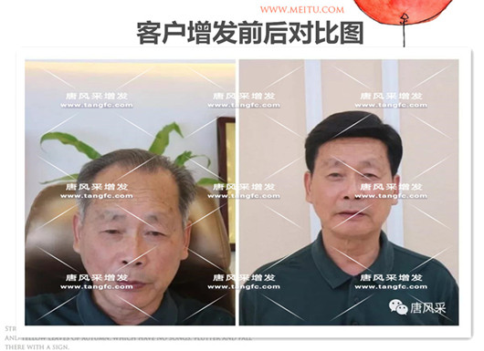 雙節(jié)同慶，給脫發(fā)的父親什么禮物，讓父親“年輕10歲”的神