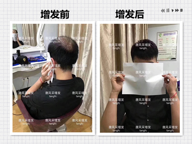 西寧補發(fā)哪里好誰知道？ 90后脫發(fā)了想做補發(fā)！