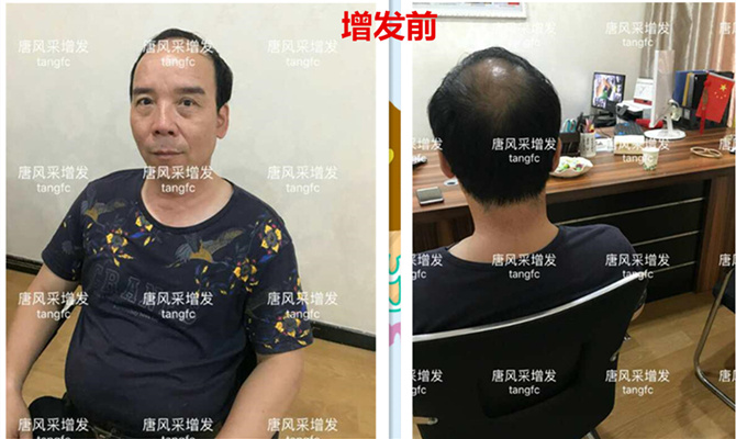 如何生發(fā)密發(fā)?到底有沒(méi)有生發(fā)奇效的藥物呢？