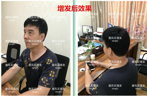 如何生發(fā)密發(fā)?到底有沒(méi)有生發(fā)奇效的藥物呢？