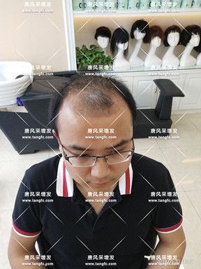 他被脫發(fā)“啃老”是與遺傳有關??！