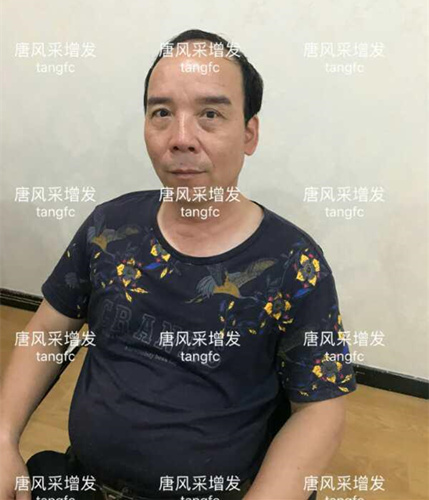 朋友碰面不敢認(rèn)，直擊發(fā)友增發(fā)后的真實(shí)改變！