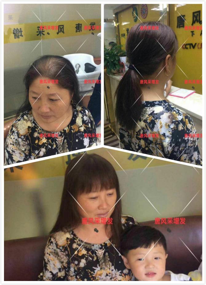 西寧織發(fā)補(bǔ)發(fā)哪家好，真的能改變我的脫發(fā)形象嗎？ 