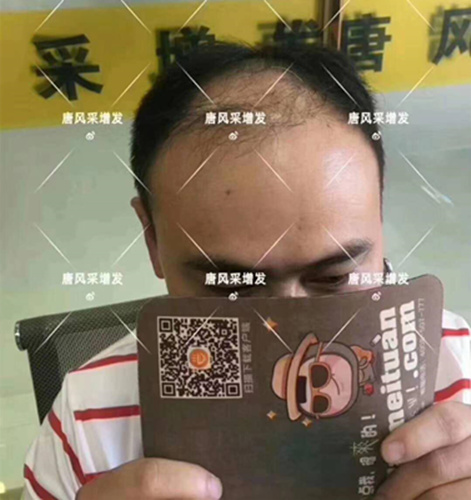 西寧織發(fā)補(bǔ)發(fā)哪家好，真的能改變我的脫發(fā)形象嗎？ 