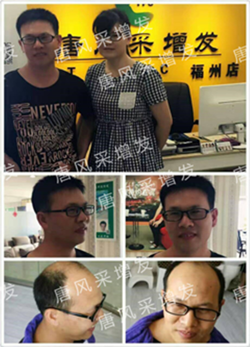 老師，我要你“脫”掉禿頂！