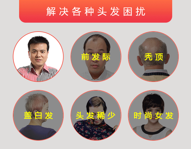 綠茶能治療脫發(fā)嗎？