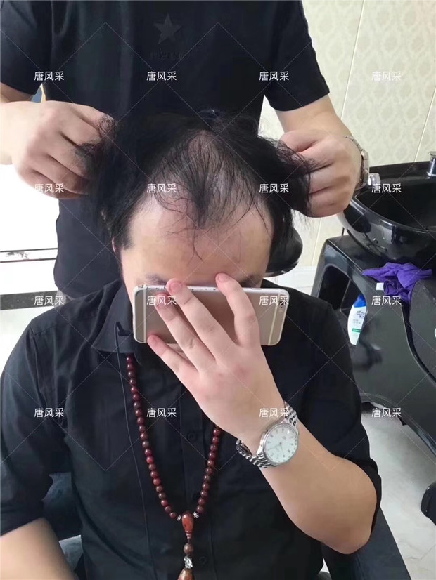 頭頂假發(fā)片 唐風(fēng)采真實(shí)案例