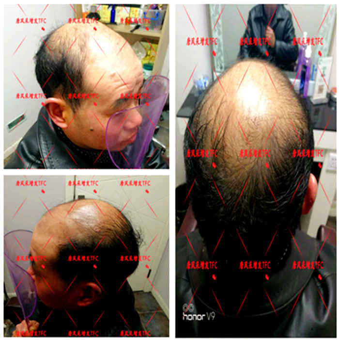 真人頭發(fā)假發(fā)套 唐風(fēng)采隱形增發(fā)客戶案例