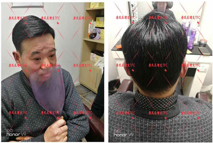 真人頭發(fā)假發(fā)套 唐風(fēng)采隱形增發(fā)客戶案例