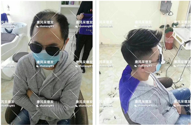 局部假發(fā)片 官方二維碼 唐風(fēng)采客戶案例 增發(fā)后