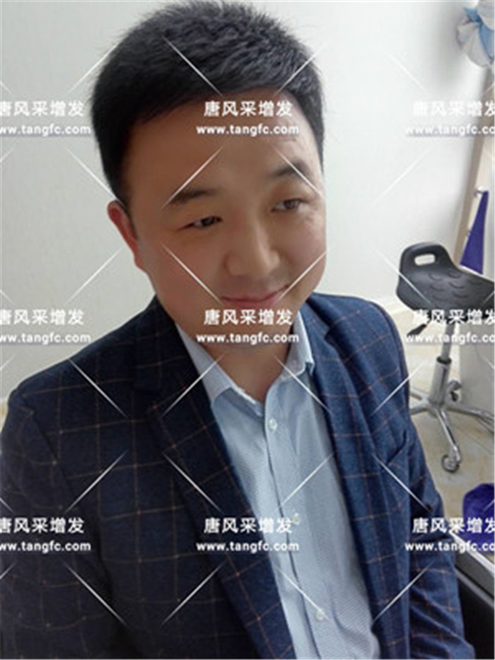 仿真頭皮假發(fā) 小吳增發(fā)后效果圖片