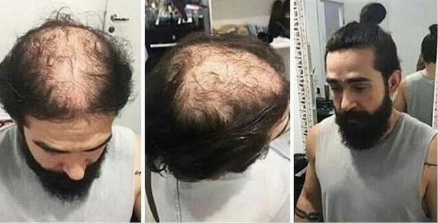 禿頂發(fā)型設(shè)計