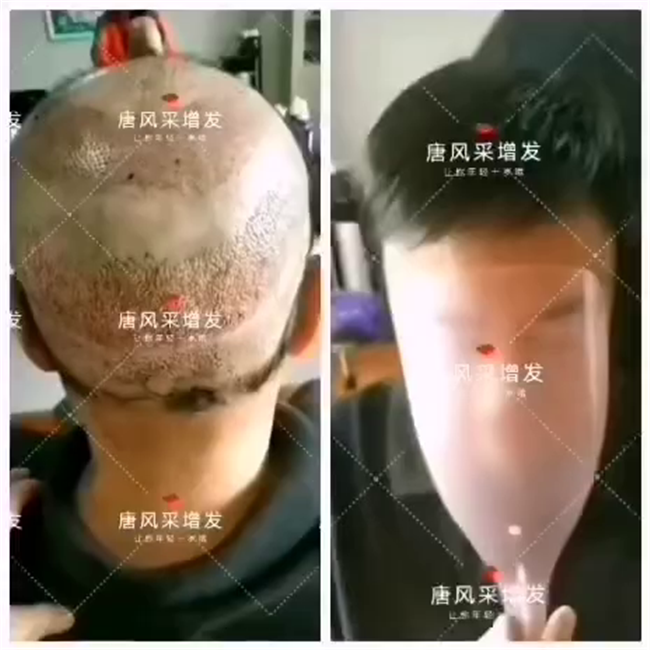 植發(fā)失敗后選擇唐風采假發(fā)