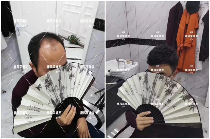 通過(guò)隱形補(bǔ)發(fā)找回帥氣