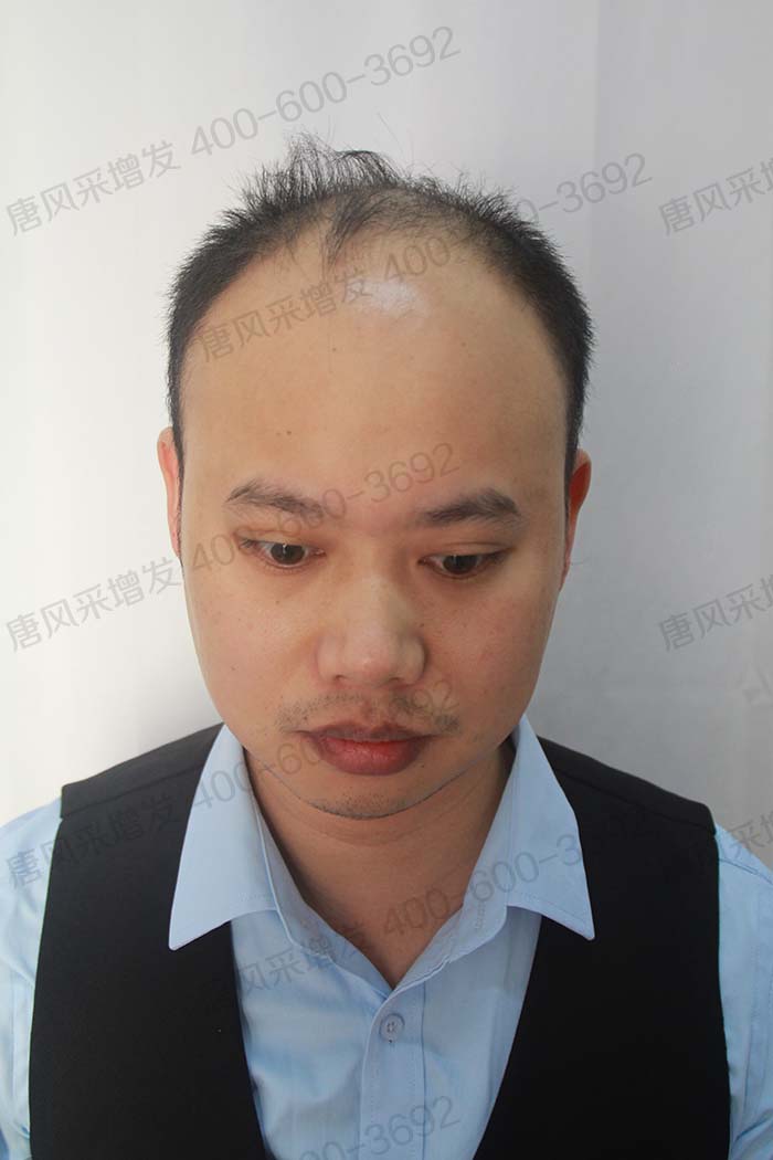 貼在頭頂?shù)募侔l(fā) \