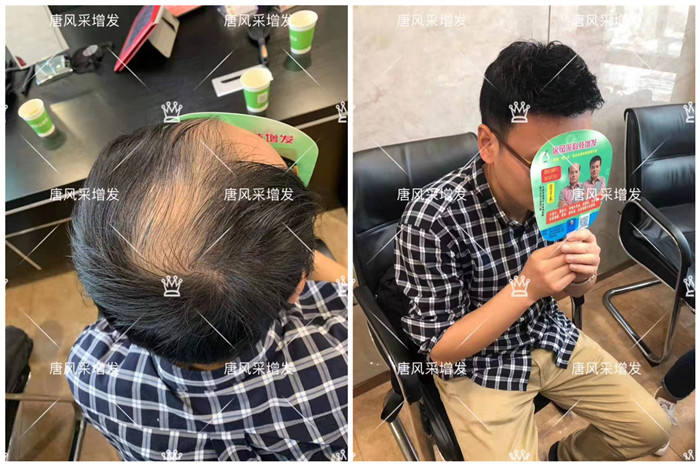 自然織發(fā)補(bǔ)發(fā)效果 \