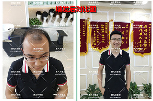 織發(fā)補(bǔ)發(fā)效果 \