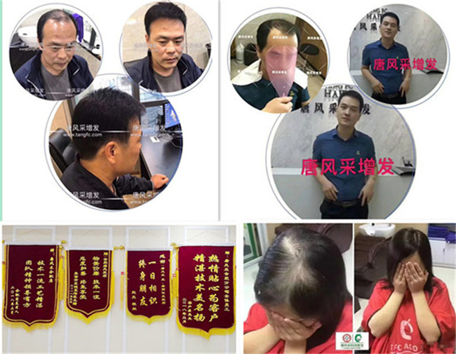 織發(fā)補(bǔ)發(fā)效果 \