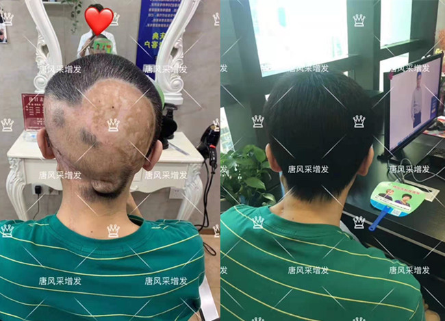 后腦勺局部假發(fā) \