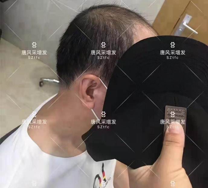 男士頭頂頂部假發(fā) \