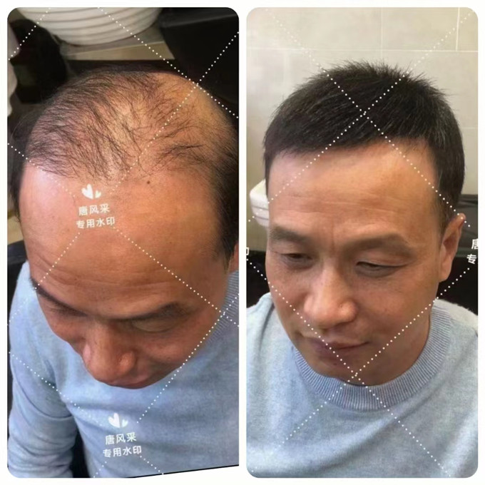 福州男士假發(fā) \