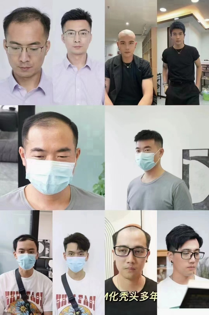 溫州隱形補(bǔ)發(fā)假發(fā) \